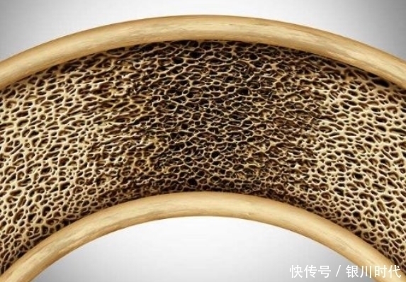 骨骼|骨质疏松“偏爱”6类人，需特别关注骨骼健康，看看你是否在其中
