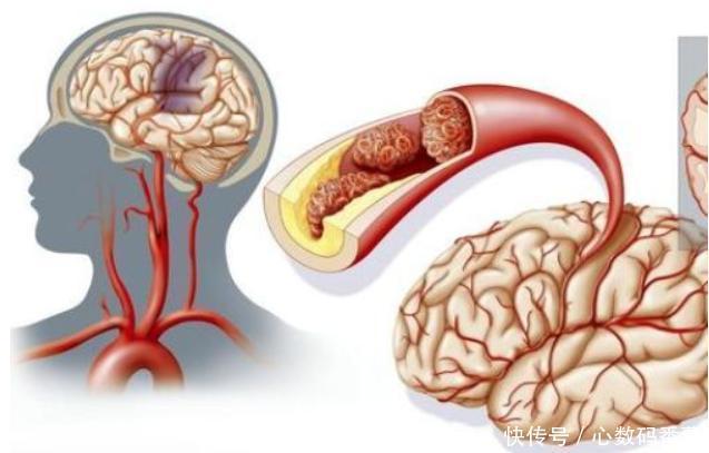 引起脑梗的“名单”被公布,肥肉并非榜首,第