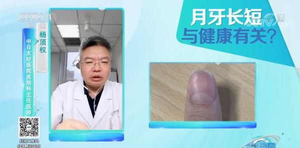 杵状甲|请低头:长这几种指甲的人注意了