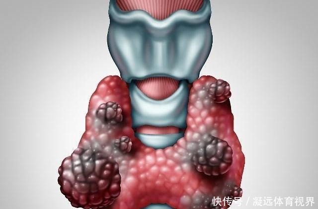 甲狀腺結節需要做手術嗎,做好2件事,結節可能會悄悄消失