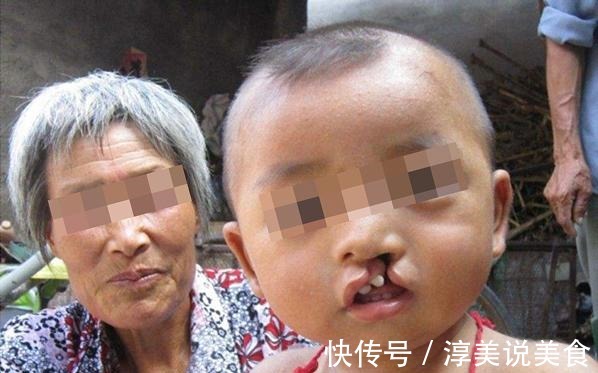 孕妇|医生三类孕妇容易生“兔唇”宝宝,如果你在其中,就要小心了