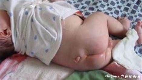 怀孕|新生宝宝竟然长了条小尾巴, 原来是妈妈怀孕时少吃了这个!
