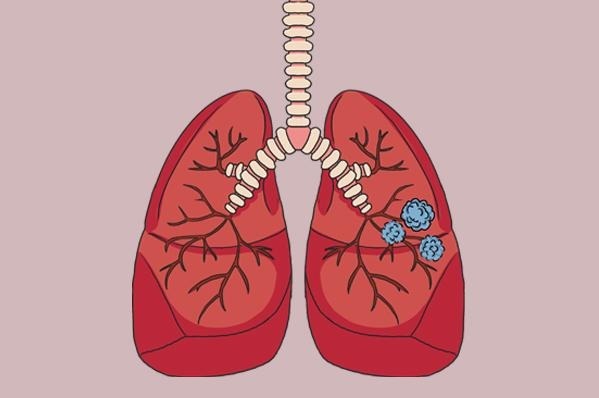 虾皮|肺结节的“发物”是虾皮胸外科医生消散肺结节,1素或可多吃