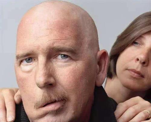 一旦头上出现三种异常,说明体内有血栓了,常吃5物,脑梗不扰