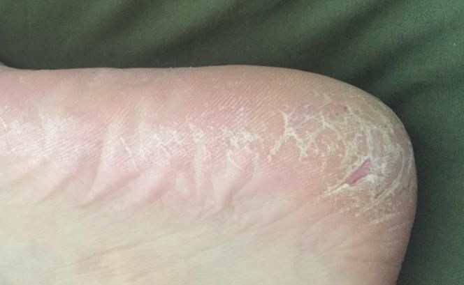 身体3处“发干”,未必是缺水所致,或许是“它”在作祟