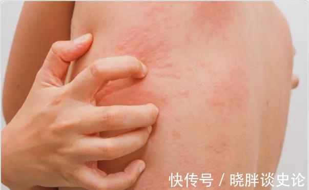 抗组胺药|宝宝得荨麻疹总是想挠怎么办？这个治疗办法百试不爽！