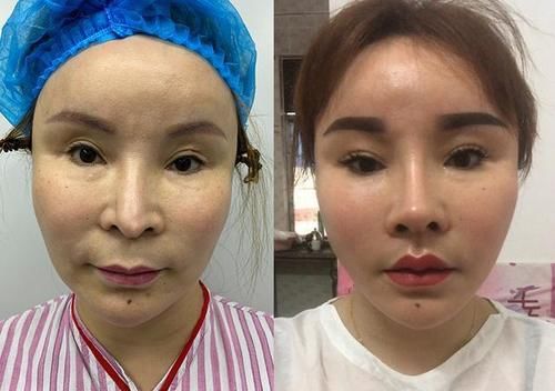 不到50岁就老成大妈？小拉皮术后6个月轻松实现逆生长！