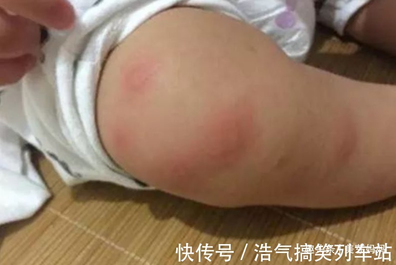 花露水|宝宝被蚊子叮咬后,第一步不是帮娃止痒,很多家长都做错了