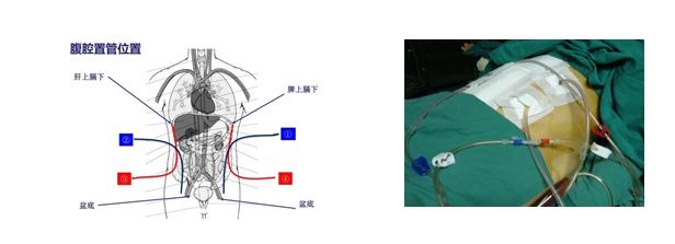 恶性肿瘤|这种“热水”能杀死癌细胞？