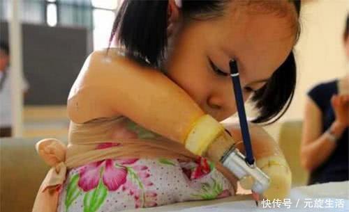 孕检|孕检发现孩子没手没脚,宝妈不顾医生劝阻坚持生,如今活成小公主