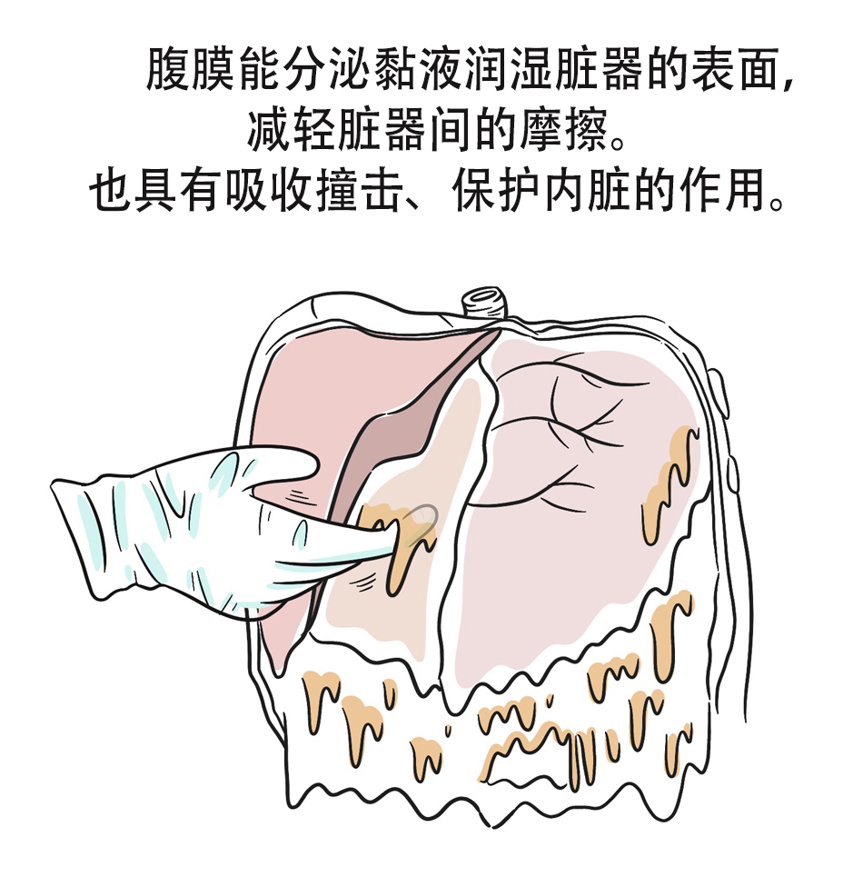 李雁|“老大难”腹膜癌能治吗?