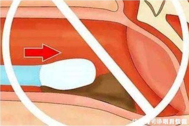 棉签|用棉签掏耳朵到底有多危险?3D动画演示,原理一目了然