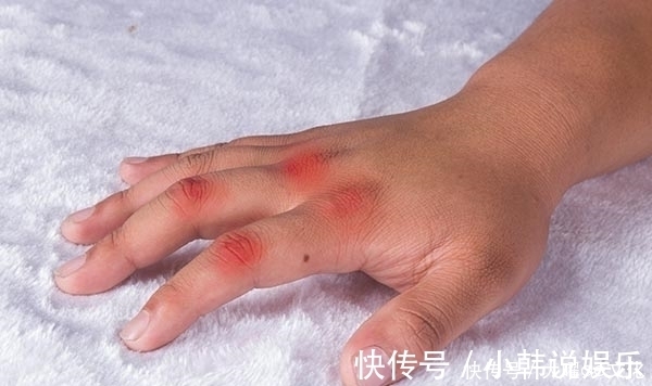 使人|尿酸升高，长出痛风石，还能逆转吗？尿酸高的人该怎么控尿酸？