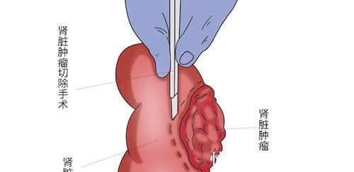 肿瘤|穿刺活检会让癌细胞扩散?哪些人需要做穿刺活检?