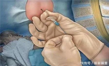 妈妈|剖腹产到底是怎么“剖”的一组图看清全过程,每个妈妈都是超人