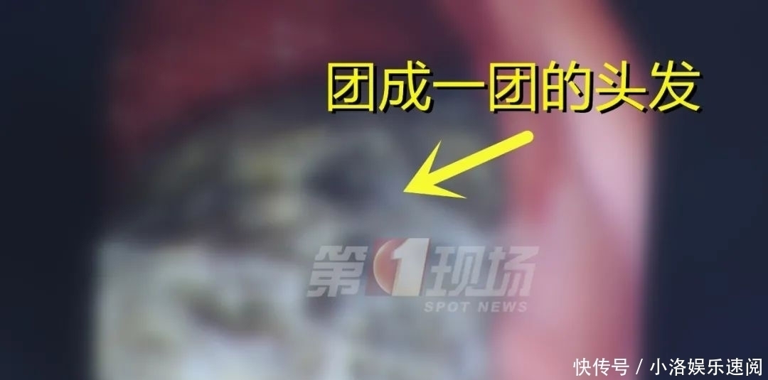 吃头发|头皮发麻14岁女孩胃里竟塞满…这个可怕习惯她保持了十年