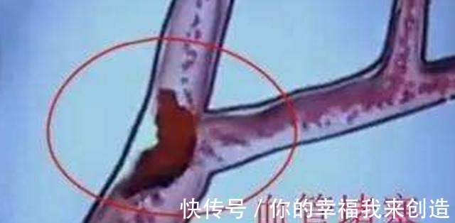 高血压|高血压, 90的140, 还要吃降压药吗 听听专家怎么说!