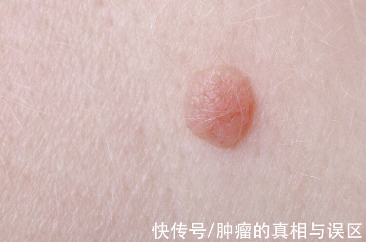 感染性疾病|脖子后的“小肉球”是什么,可以用手直接抠掉吗?下手前要三思