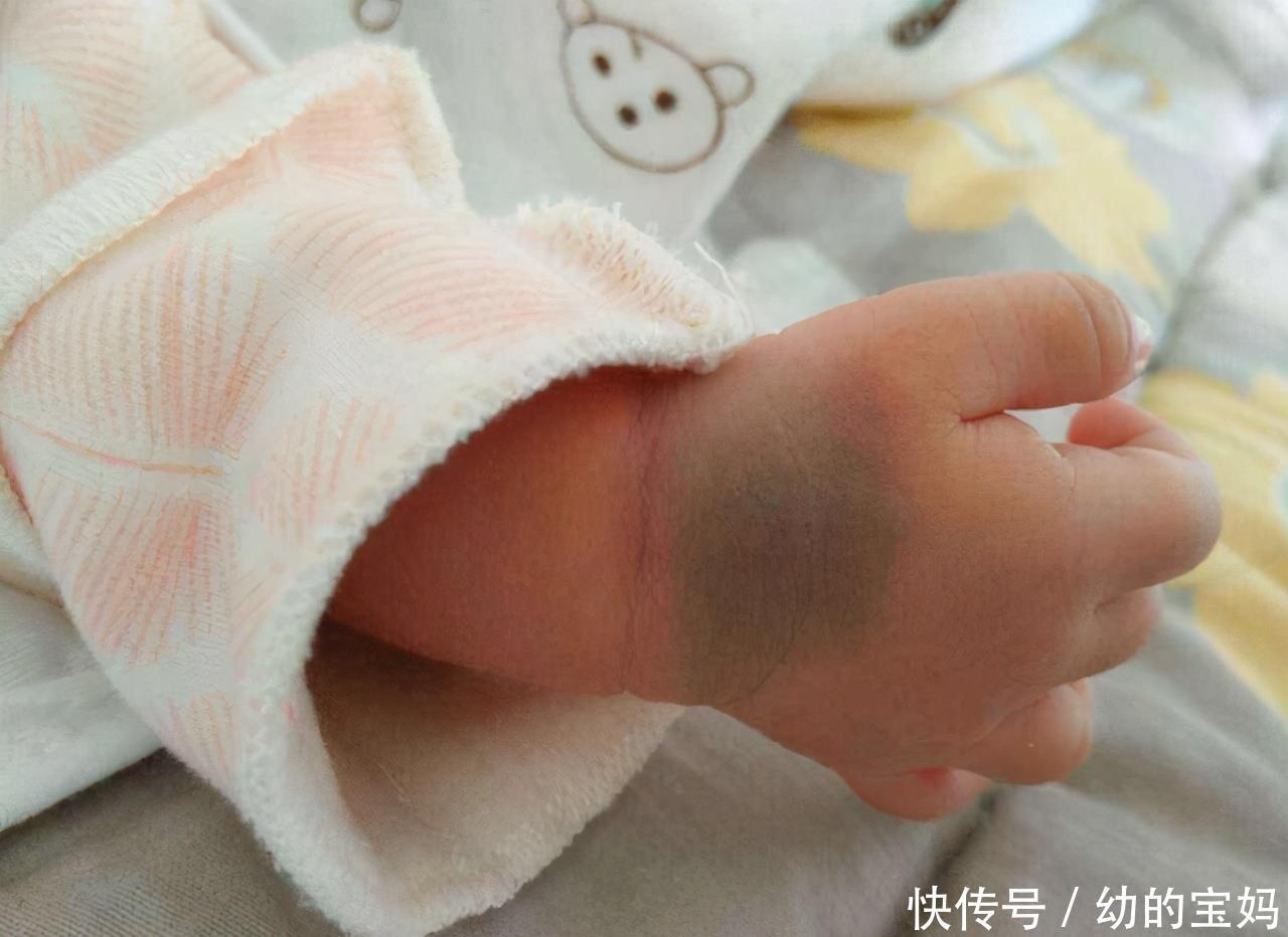 蒙古斑|“屁股青,淘人精”宝宝屁股“淤青”的秘密,你知道多少