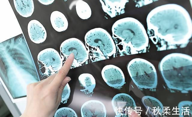 血管|脑梗发作只需21秒,医生有这3个习惯,血管不堵,脑梗不敢来