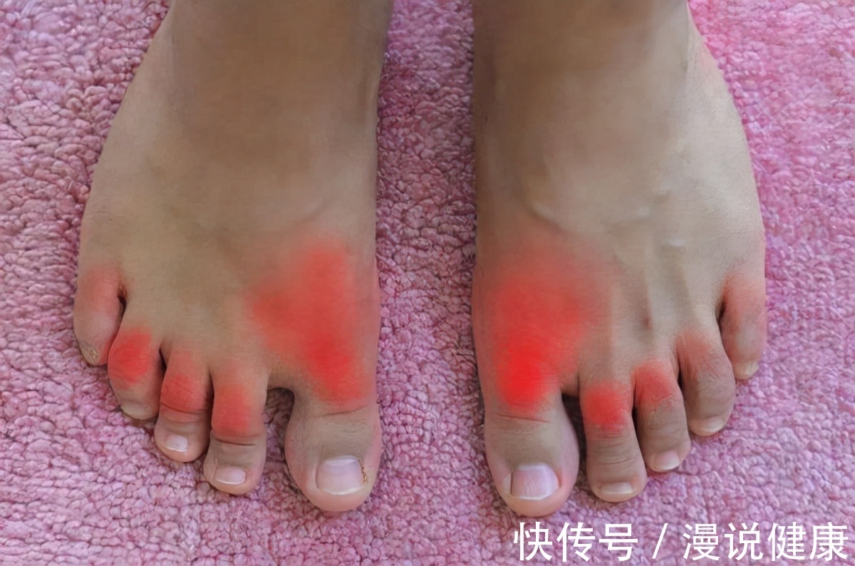 不良习惯|我国高尿酸患者达到1.7亿!这7个习惯不改,难免痛风会来折磨你