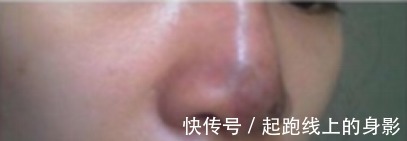 风险 鼻炎能做隆鼻手术吗隆鼻之后会有哪些术后风险!