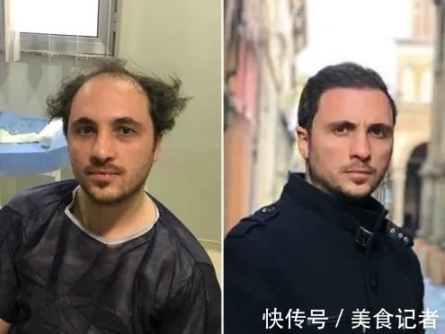 chris 每个月到底有多少人去土耳其植发？