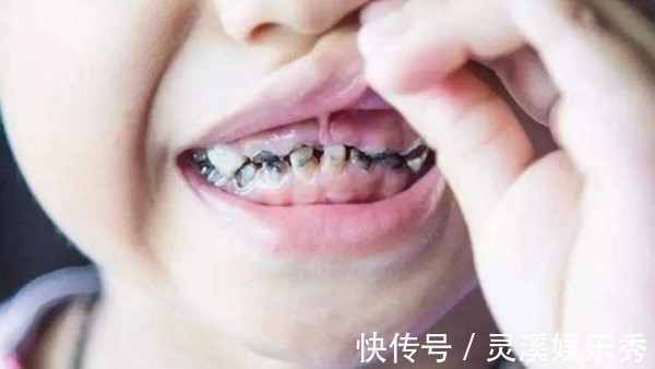 小黑牙|3岁孩子满嘴”小黑牙“!医生怒斥:不是糖果,是家长太无知!