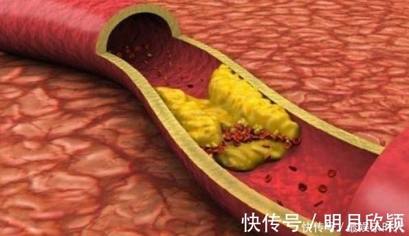 疏通血管|高血脂“害怕”的几种食物,每天吃一些,有助疏通血管,预防血栓