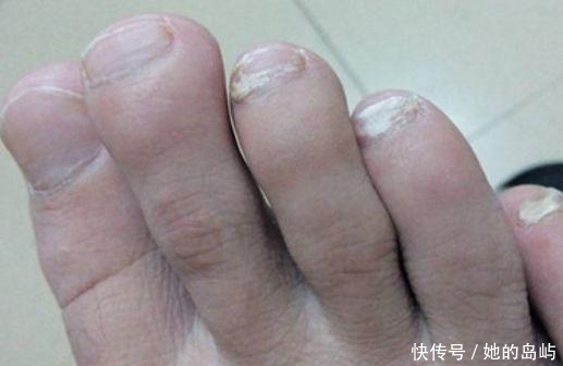 脚后跟|肾好不好要看脚,脚上若没有出现这3种情况,说明你的肾很健康!