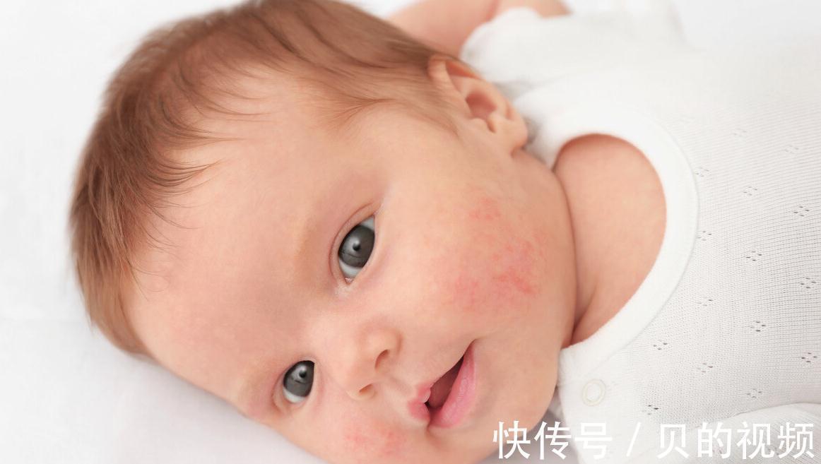 宝宝|婴儿长湿疹怎么办?新手宝妈别慌,做好这3点,宝宝白白净净