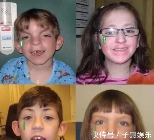 发育不良|宝宝长得太漂亮也是一种病?“歌舞伎综合征”到底是个什么鬼