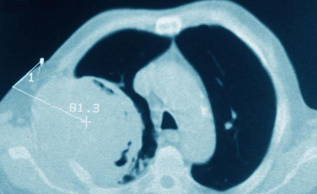 肺癌|只看CT就给人诊断肺癌,患者化疗被化掉半条命,结果是其他毛病