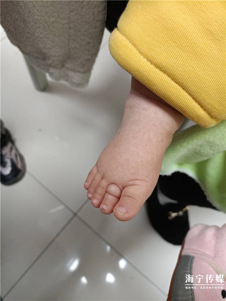 截趾|心疼！海宁七个月宝宝脚趾差点遭截趾，你家可能也有这危险…