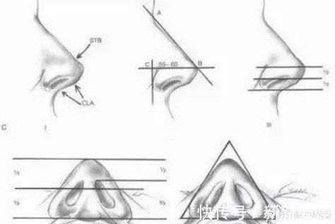 假体|为什么你做的隆鼻没达到预期效果?吸取教训,这些雷别踩!