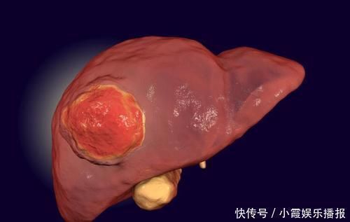 雌性激素|肝脏癌变身体会有信号吗？医生：有很多关键症状，占一个也要重视
