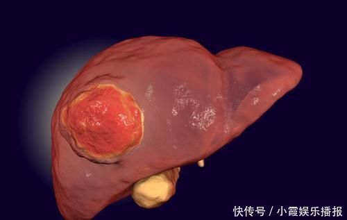 雌性激素|肝脏癌变身体会有信号吗?医生:有很多关键症状,占一个也要重视