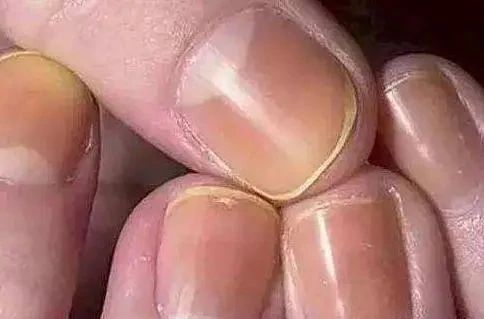 肝受损时,指甲会有一些“表现”,切莫忽视