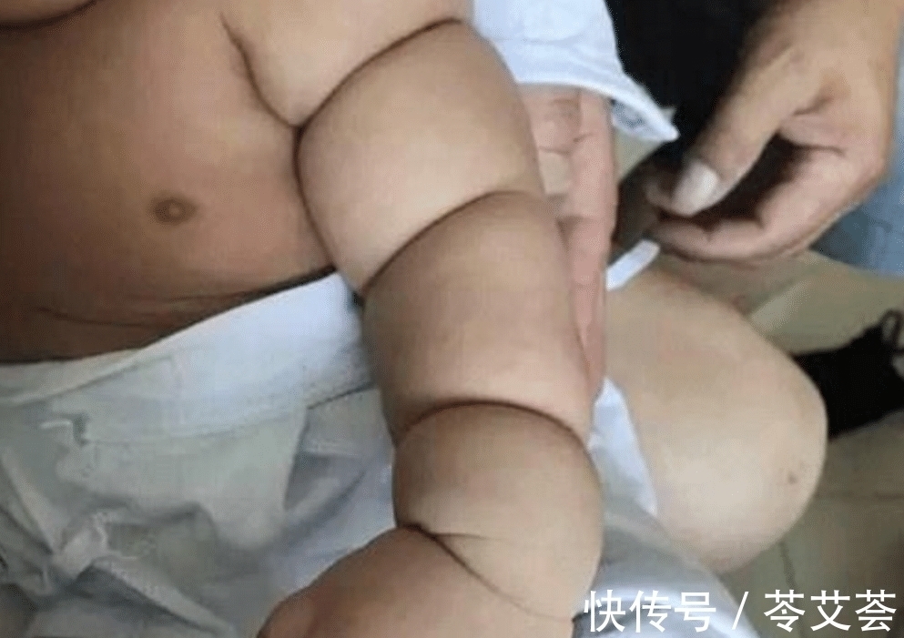 孩子|五个月男婴体重三十斤,家人带孩子常规体检,却要面临截肢的危险