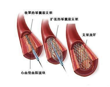 低密度脂蛋白|降血脂、软化血管、清理血管垃圾,不能只依靠药物,更要依靠自己