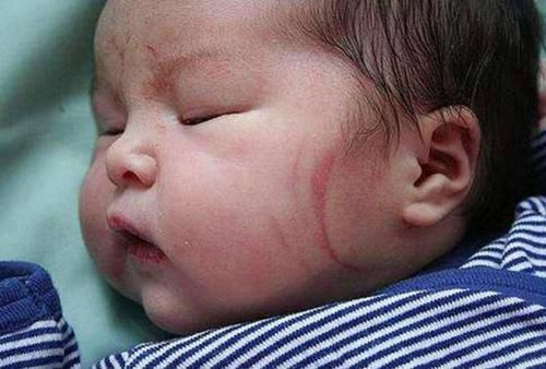 医生|6个月宝宝产钳印明显,奶奶找医生“算账”,医生的话让她脸红