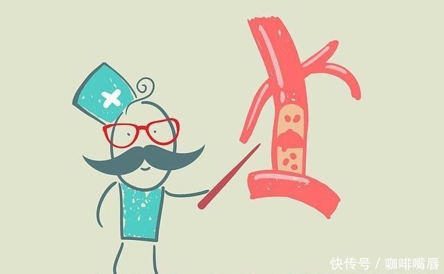 颈动脉|颈动脉斑块,是从哪里来的?能够缩小或消退吗?