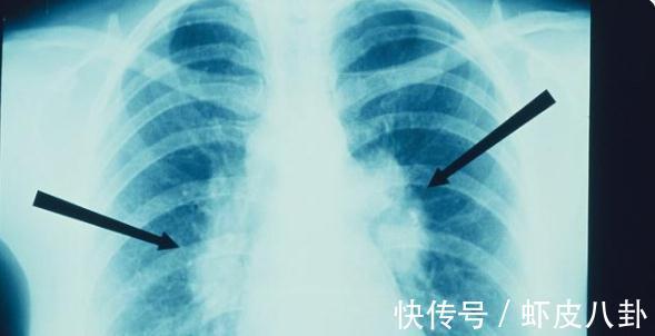 乳腺结节|结节就是早癌？作为全身几十枚结节的医生，有些话想对结节患者说