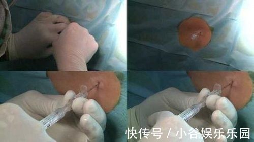 半麻|剖腹产的半麻和全麻,到底有什么区别?后者关系到胎儿健康