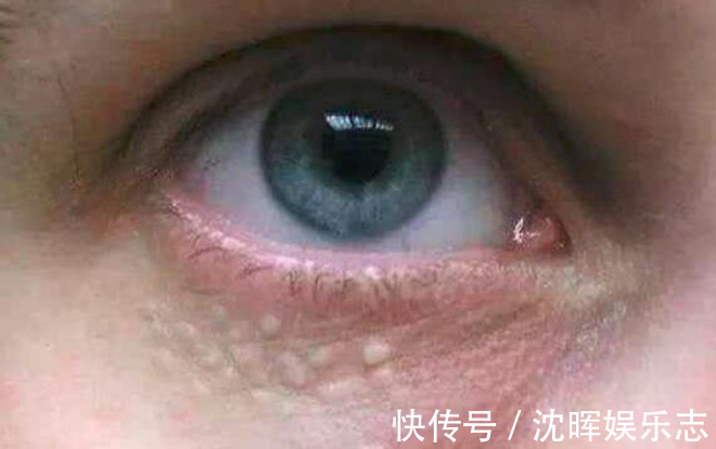 眼角|眼角的脂肪粒怎么消除教你2招,不用针挑也不用手抠,轻松消除