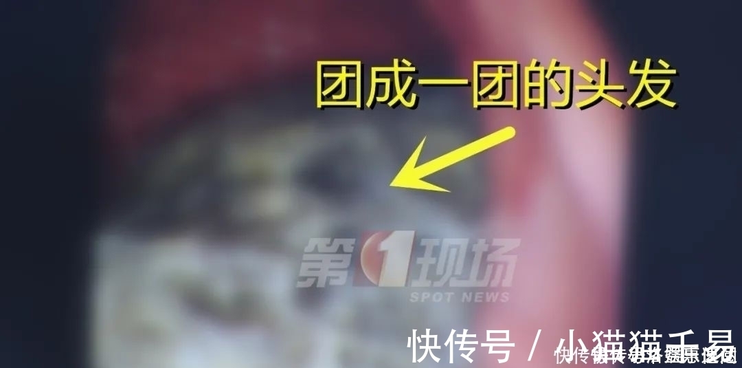 手术治疗|头皮发麻14岁女孩胃里竟塞满…这个可怕习惯她保持了十年