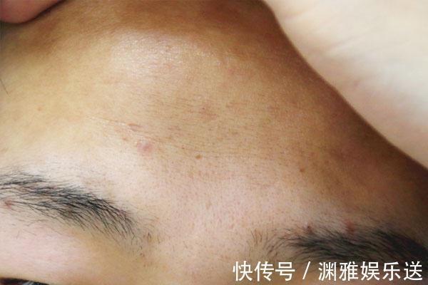 黄褐斑|子宫不太好的女性，脸上或会出现四种表现，若都没有，子宫很健康