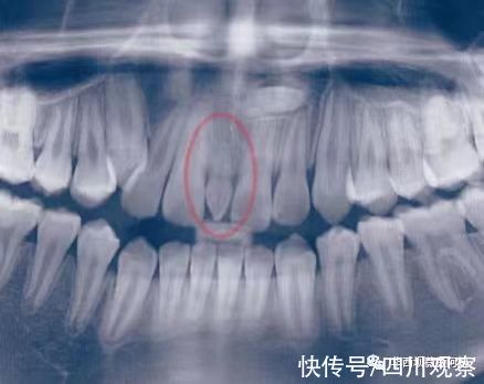 门牙|过年回家被人说孩子牙齿长丑了要箍？华西口腔专家教你辨别