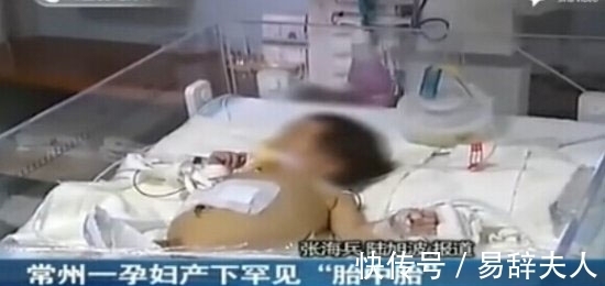 医生|【奇闻】孕妇产下“胎中胎”:刚出生8天女婴竟怀孕?
