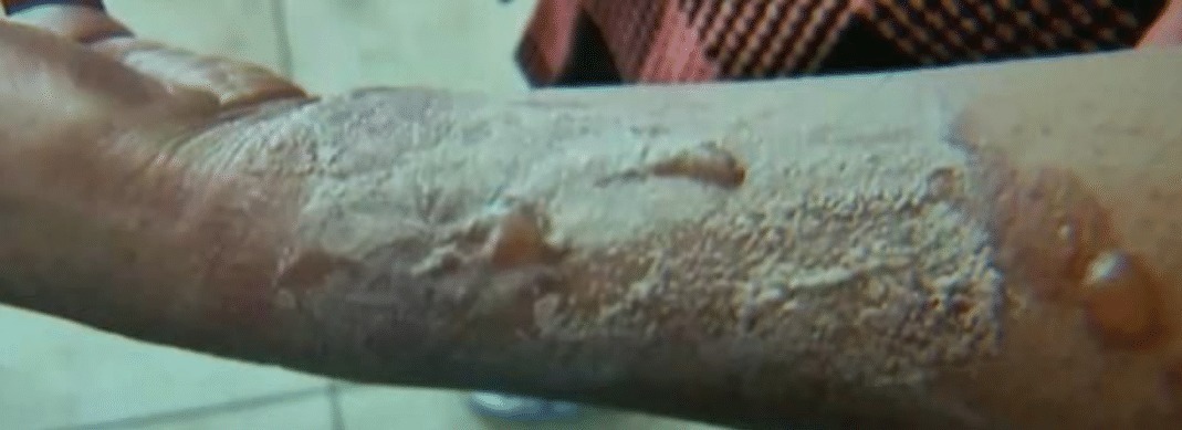 索赔|女子网购水壶,用了3年手柄断裂手导致烫伤,向京东索赔3000